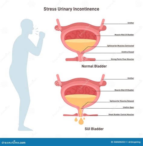 Stress Urinary Incontinence Leakage Of Urine During Moments Of