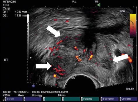 Figure From Applications Of Transrectal Ultrasound In Prostate