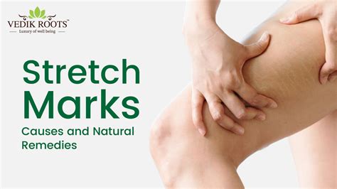 Bye Bye Stretch Marks Causes And Natural Remedies Vedikroots