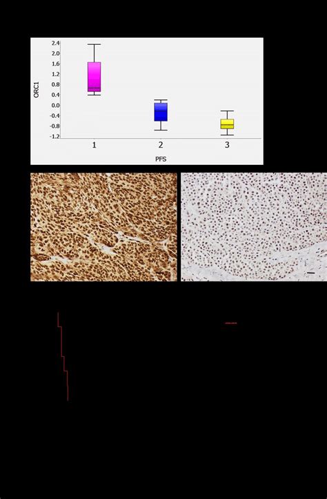 High Orc Protein Expression Correlates To A Poor Clinical Outcome A