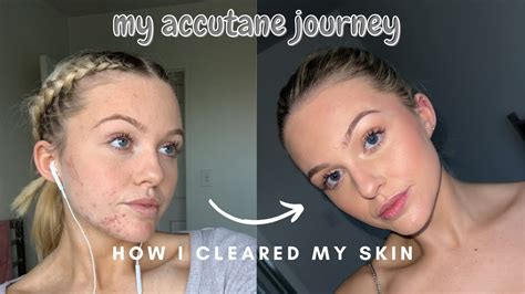 How I Cleared My Skin My Accutane Journey Youtube