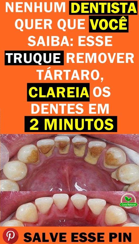 Os Rem Dios Caseiros Para Remover Os T Rtaros Como Remover