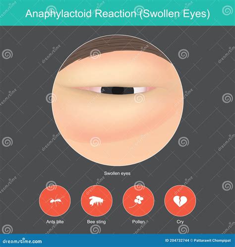 Anaphylactoid Reaction. Illustration Show Close Up. Stock Vector - Illustration of human ...