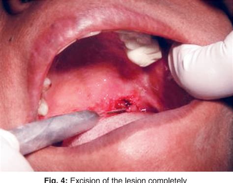 Figure 1 From Management Of Oral Pyogenic Granuloma With 940 Nm Diode