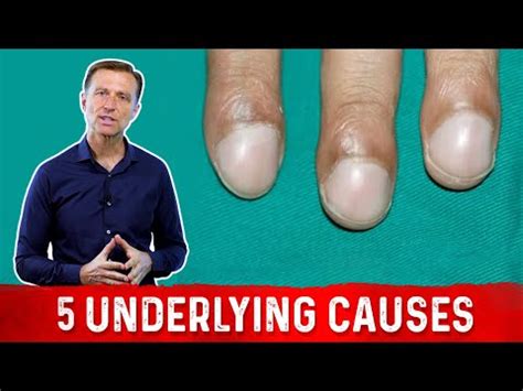 What Causes Clubbing of the Nail? – Health News Disclosure