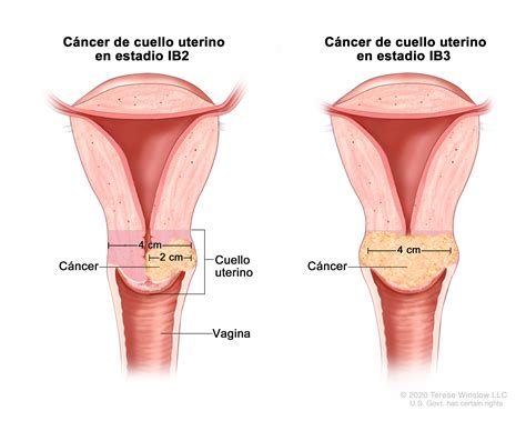 Estadios Del C Ncer De Cuello Uterino