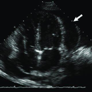 Derrame pericárdico la vista de cuatro cámaras del corazón muestra un