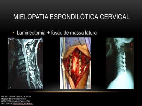 Mielopatia EspondilÓtica Cervical