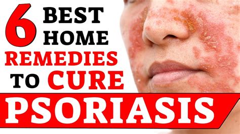 Best 6 Remedies To Cure Psoriasis Psoriasis Treatment Bharat Homeopathy Youtube