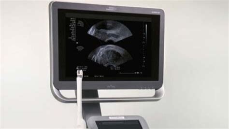 Siemens Acuson ACUSON NX3 Ultrasound System - Fokus Diagnostic Indonesia