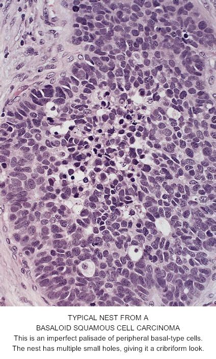 Pathology Outlines Basaloid Squamous Cell Carcinoma