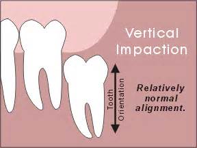 Understanding The Different Types of Wisdom Tooth Impaction - Wisdom ...