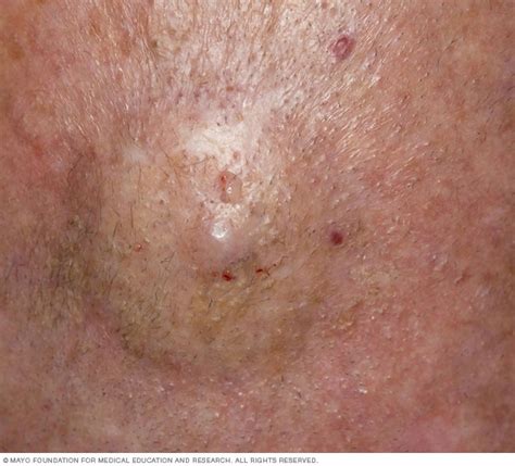 Cutaneous B Cell Lymphoma Mayo Clinic