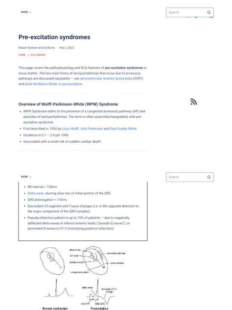 Pre Excitation Syndromes Litfl Ecg Library Diagnosis Download