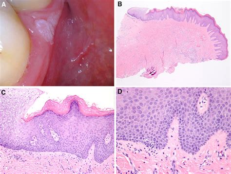 Hyperkeratosis Papillomatosis And Mild Chronic Inflammation Not