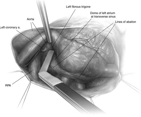 Total Thorascopic Ablation Of Atrial Fibrillation Using The Dallas