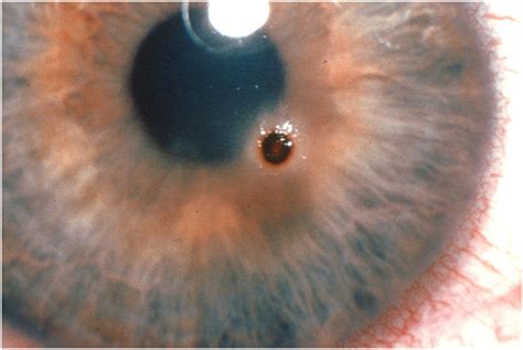 Corneal Abrasions Phoenix Eye Doctors