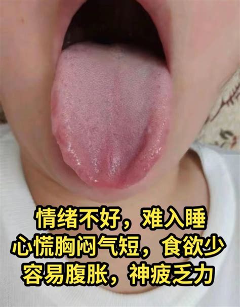 粉丝舌象案例分析，肝郁、脾虚、湿热、瘀血、你是哪一种？ 哔哩哔哩