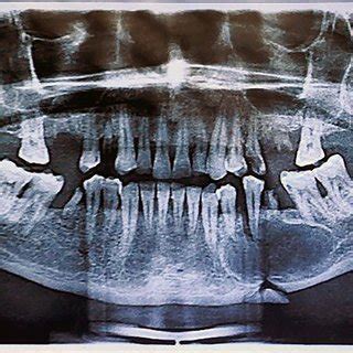 Orthopantomogram OPG Showing A Pathological Fracture Of The Left