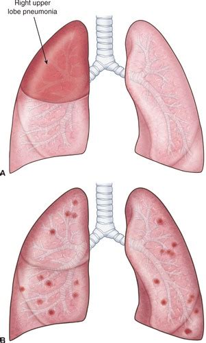 Ch 24 Respiratory Disorders Flashcards Quizlet