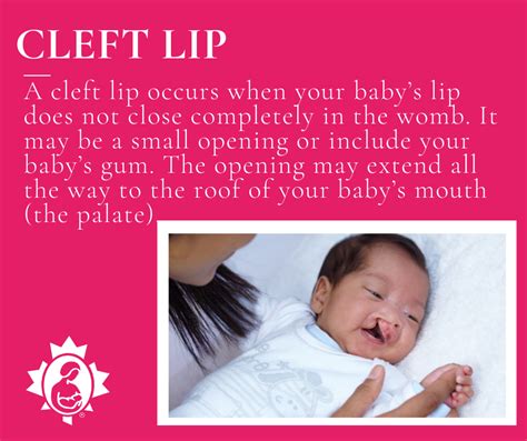 Feeding A Baby With A Cleft Lip Andor Cleft Palate La Leche League