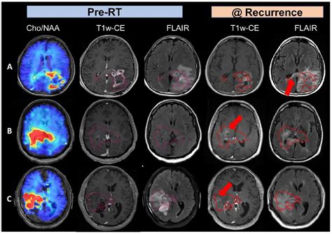 Figure From Final Report On Clinical Outcomes And Tumor Recurrence