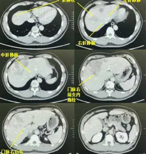 变不治为可治！“介入靶免”强强联合为肝癌晚期患者搏出生路肝癌手术肝脏新浪新闻