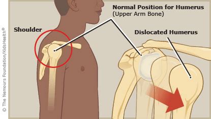 A To Z Dislocation Shoulder For Parents Nemours