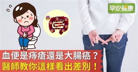 血便是痔瘡還是大腸癌？醫師教你這樣看出差別！ 早安健康 Line Today