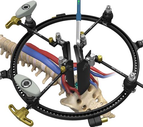 Anterior Lumbar Interbody Fusion (ALIF) - ATEC Spine