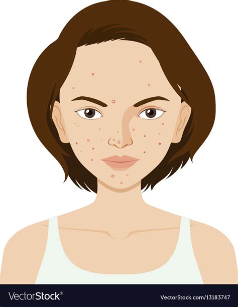 Woman Face With Pimples Royalty Free Vector Image