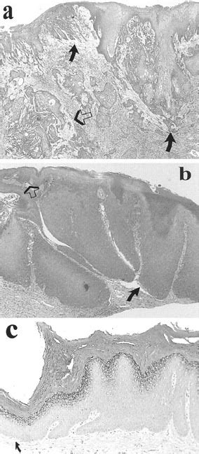 Photomicrograph Of An Invasive Squamous Cell Carcinoma Scc Solid Download Scientific Diagram