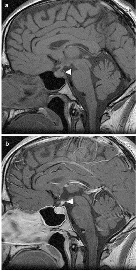 A Unenhanced T1 Weighted Sagittal Image Through The Pituitary Gland