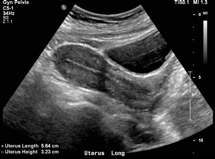 Female Pelvic Ultrasound Radiology Reference Article Radiopaedia Org