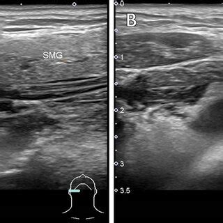 -Submandibular ultrasound. (A) Right submandibular gland which measures ...