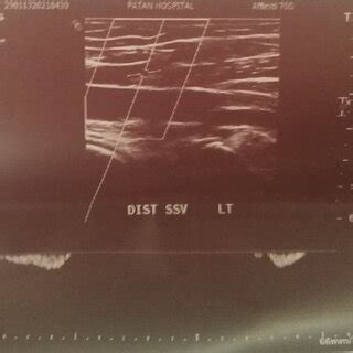 Doppler of proximal end of Superficial Saphenous Vein | Download ...