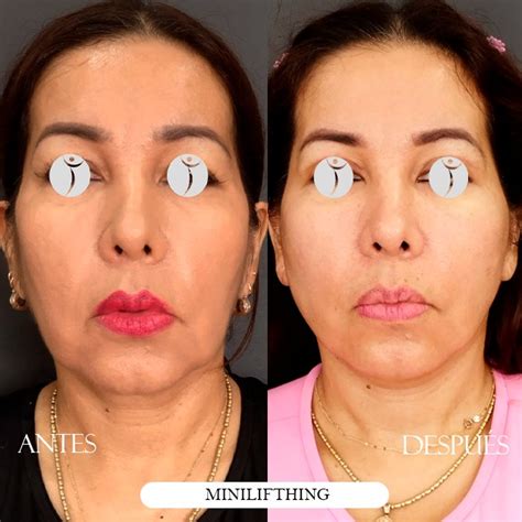 Minilifting Facial Rejuvenece Tu Rostro De Forma Naturall