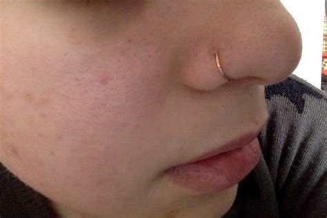 Nose Piercing Bump How To Get Rid Of It Atelier Yuwa Ciao Jp