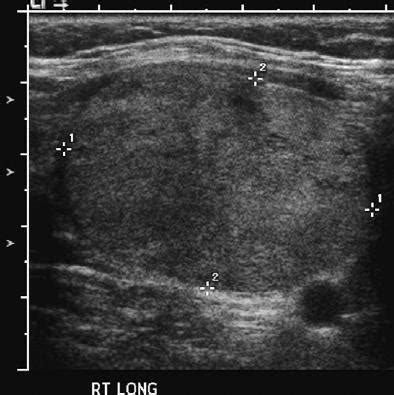 Thyroid Ultrasound > Top 10 Pathology > 4. Follicular Carcinoma