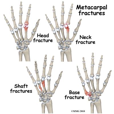 Metacarpal Fractures - Physiopedia