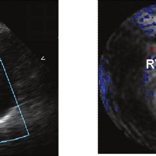 Muscular VSD. Short-axis views from echocardiography and real-time... | Download Scientific Diagram