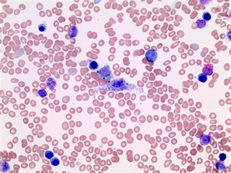 Pathology Outlines Systemic Mastocytosis