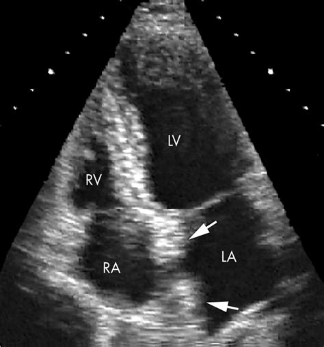 Lipomatous Hypertrophy Of The Interatrial Septum A Commonly