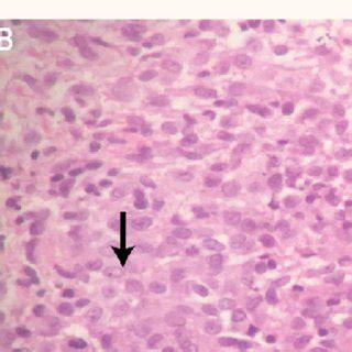 A Haematoxylin And Eosin H E Stain Of A Punch Biopsy At X