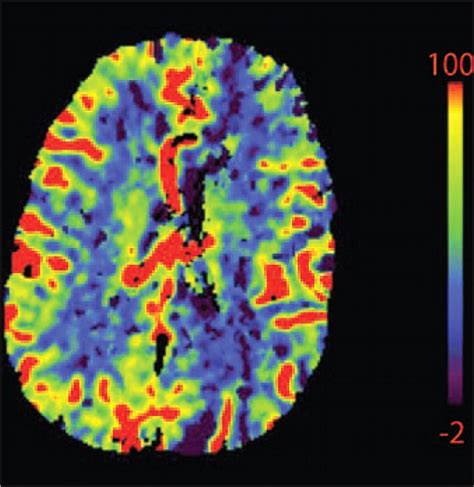 Imaging Of Stroke Part Perfusion Ct Overview Of Imaging Technique