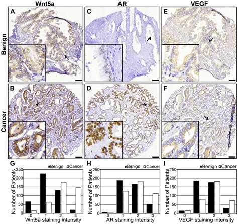 Immunohistochemical Expression Of Wnt5a AR And VEGF In Tissue