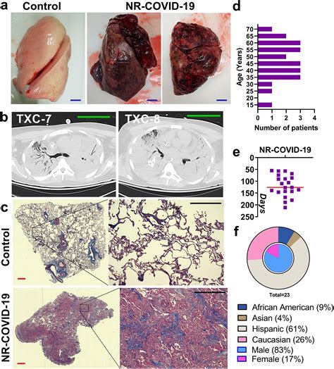 Fulminant Lung Fibrosis In Non Resolvable Covid Requiring