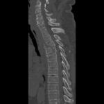 thoracic spine compression fracture symptoms Archives - Samarpan ...