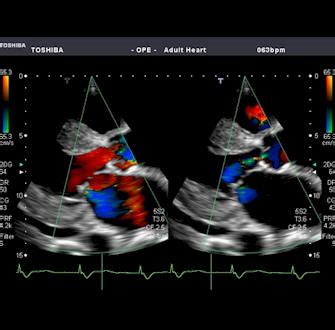 What is Cardiac Ultrasound and How is it Used?