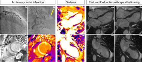 Concurrent Acute Coronary And Takotsubo Syndrome Two In One The